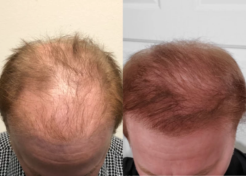 Mr.p497 Hair Transplant Before and After