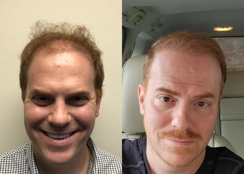 Mr.p498 Hair Transplant Before and After