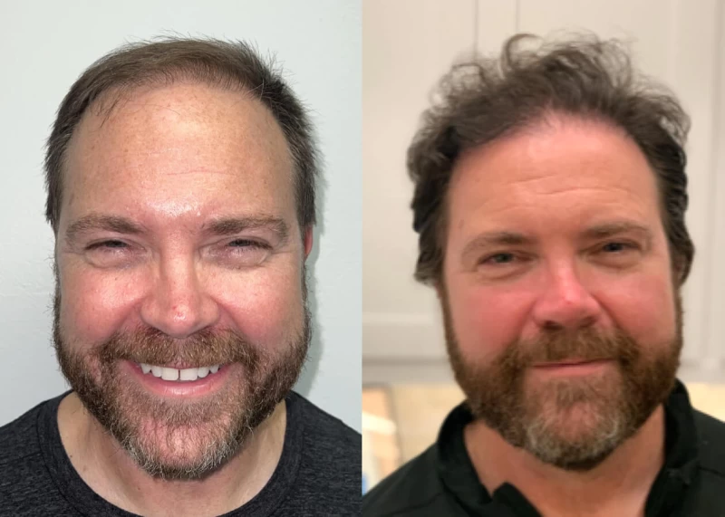 Mr.p499 Hair Transplant Before and After