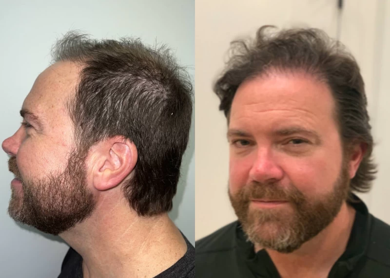 Patient p499 hair transplant before and after left view