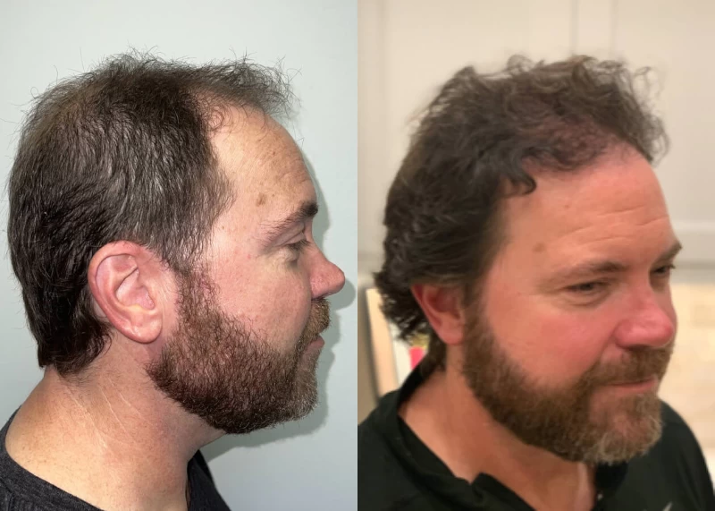 Patient p499 hair transplant before and after right view