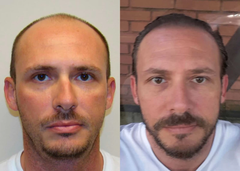 Alex Hair Transplant Before and After