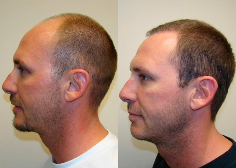 Patient p49 hair transplant before and after left view