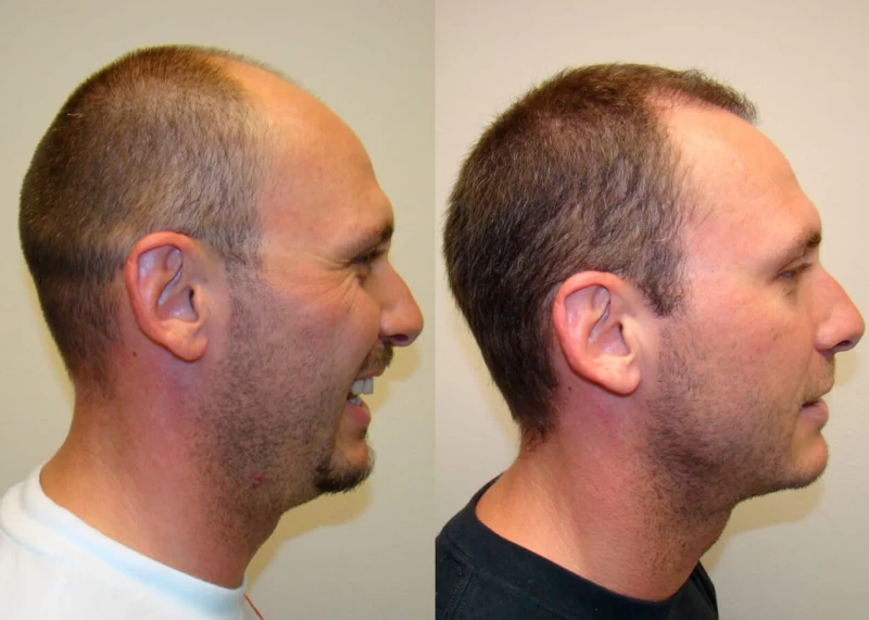 Patient p49 hair transplant before and after right view