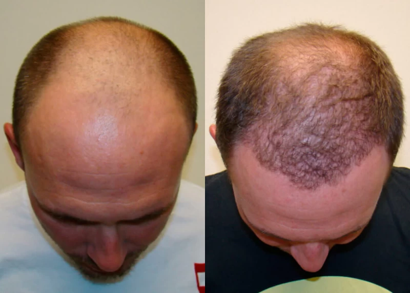 Patient p49 hair transplant before and after tilt view