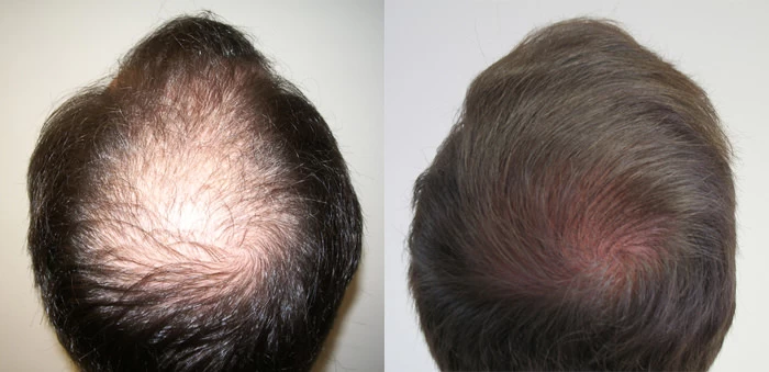 Patient p4 hair transplant before and after crown view
