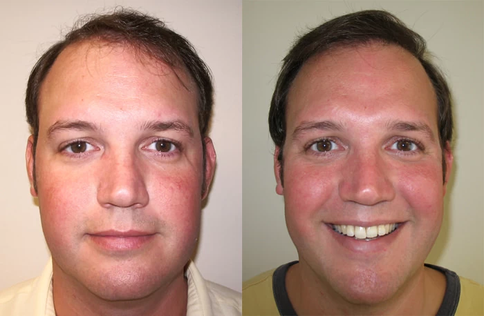 Jodi Hair Transplant Before and After