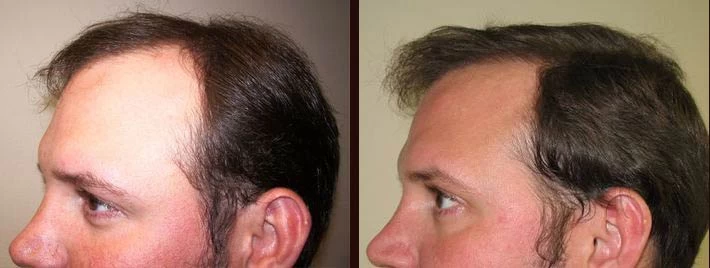 Patient p4 hair transplant before and after left view