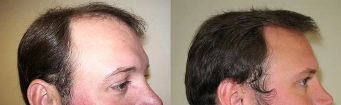 Patient p4 hair transplant before and after right view