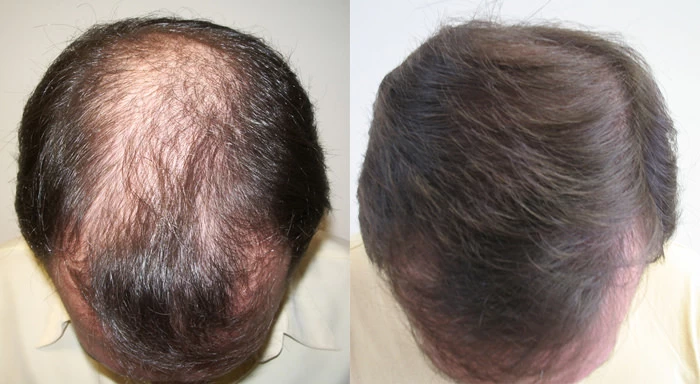 Patient p4 hair transplant before and after tilt view