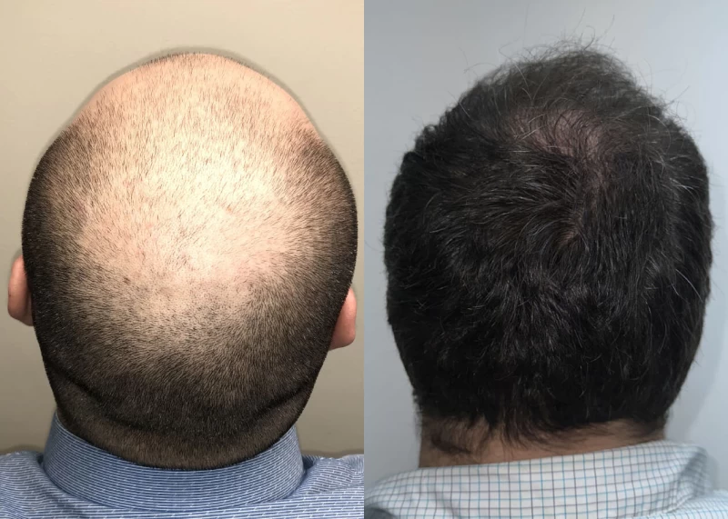 Patient p500 hair transplant before and after crown view