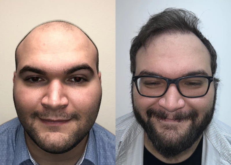 Zack Hair Transplant Before and After