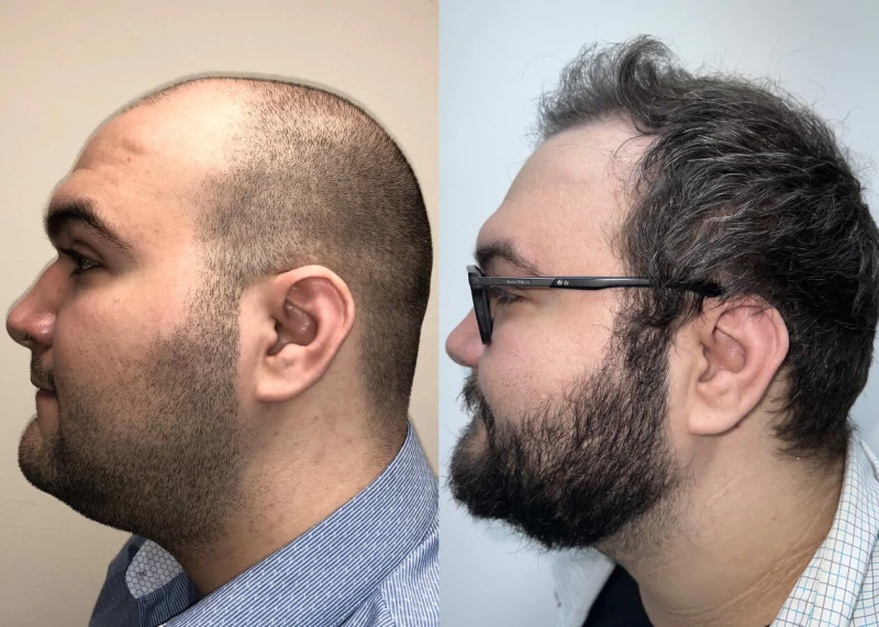 Patient p500 hair transplant before and after left view