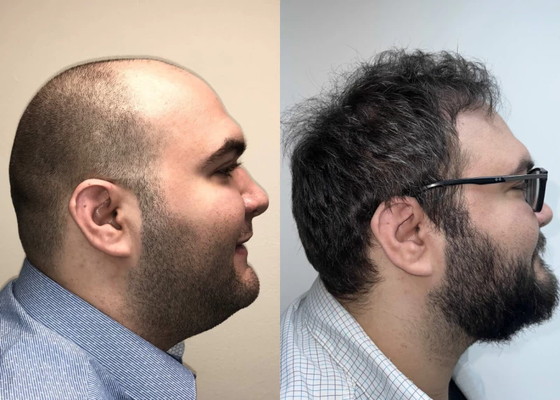 Patient p500 hair transplant before and after right view