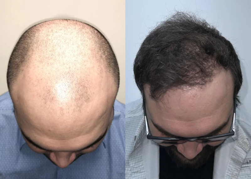 Patient p500 hair transplant before and after tilt view