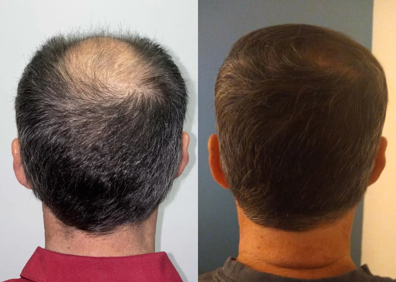 Patient p501 hair transplant before and after crown view