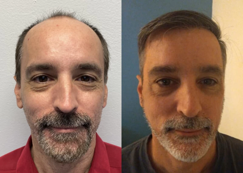 Jorge Hair Transplant Before and After