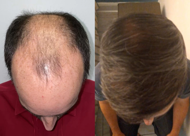 Patient p501 hair transplant before and after tilt view