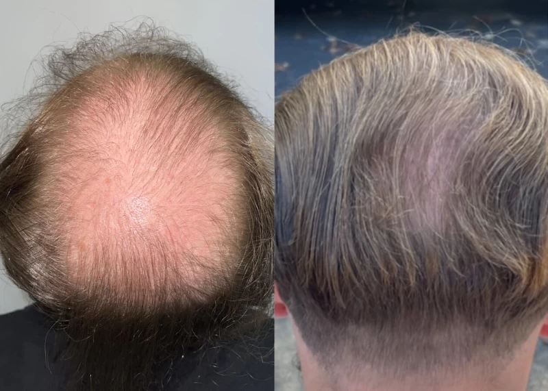 Patient p502 hair transplant before and after crown view