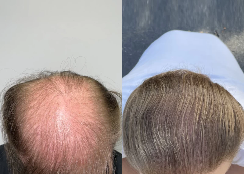 Patient 502 Hair Transplant Before and After