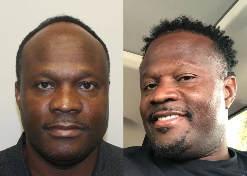 Olest Hair Transplant Before and After