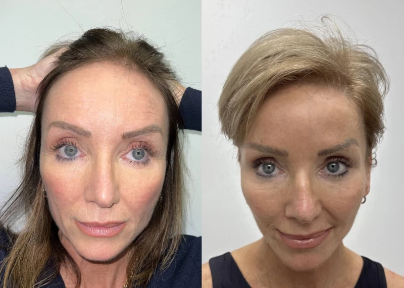 Louisa  Hair Transplant Before and After