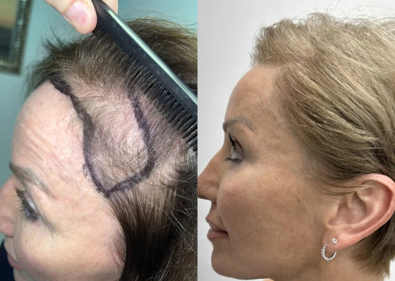 Patient p504 hair transplant before and after left view