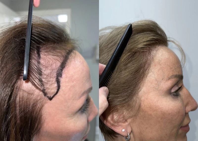 Patient p504 hair transplant before and after right view