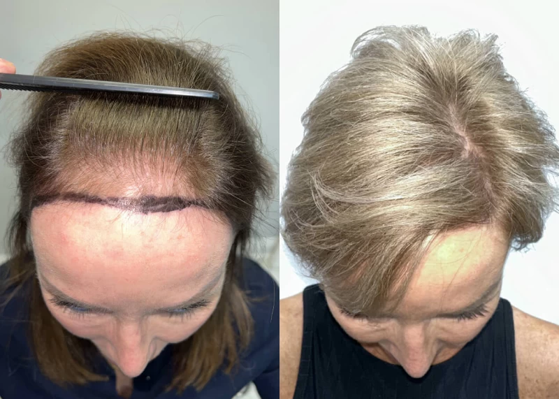 Patient p504 hair transplant before and after tilt view