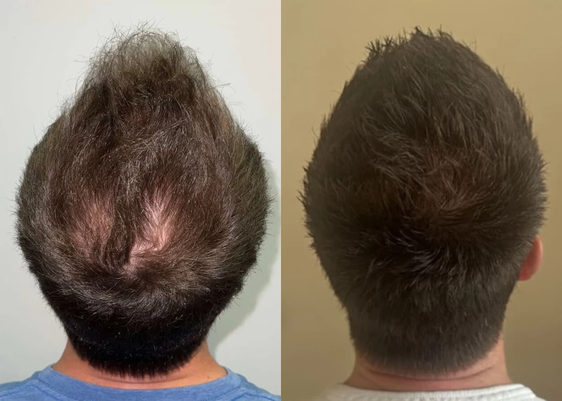 Patient p505 hair transplant before and after crown view