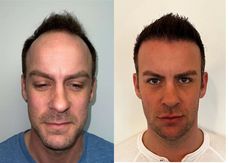 Francis Hair Transplant Before and After