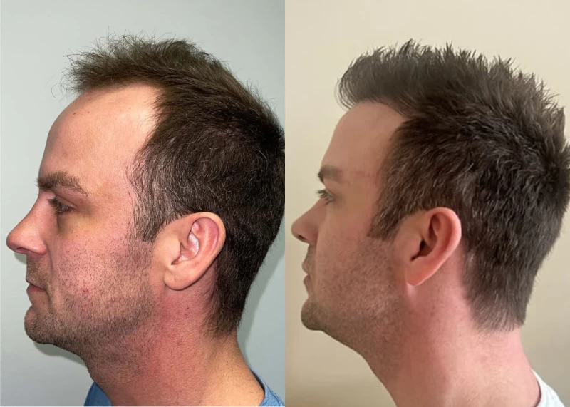Patient p505 hair transplant before and after left view