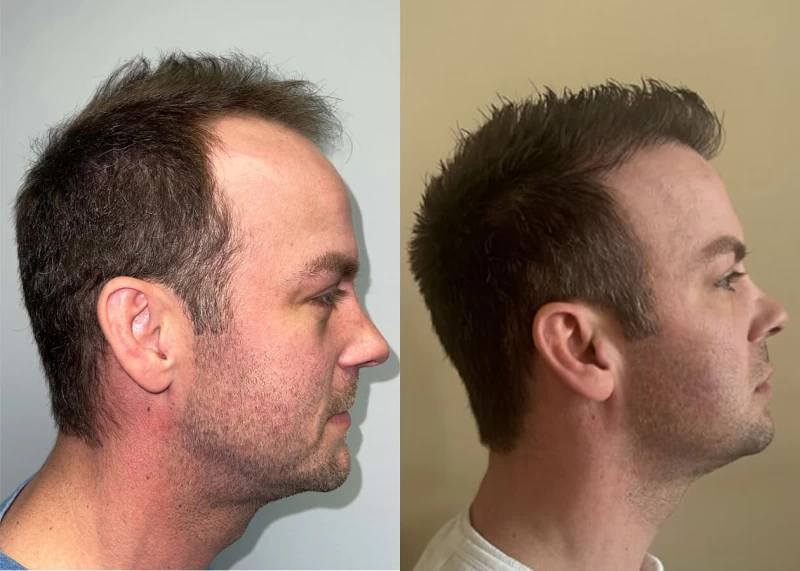 Patient p505 hair transplant before and after right view