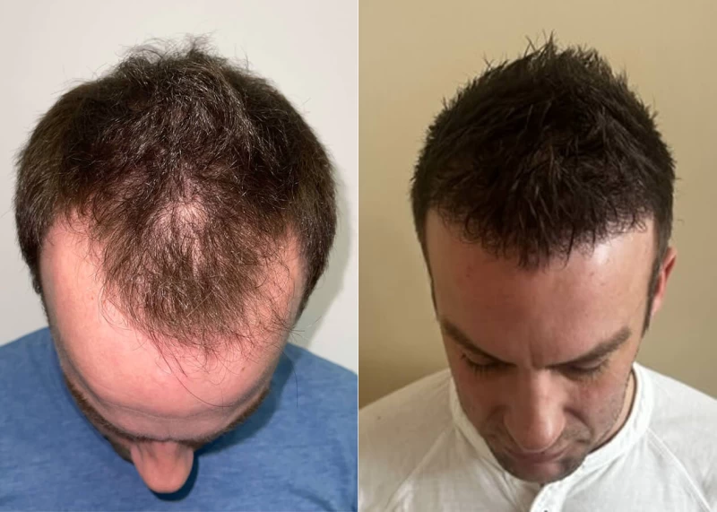 Patient p505 hair transplant before and after tilt view