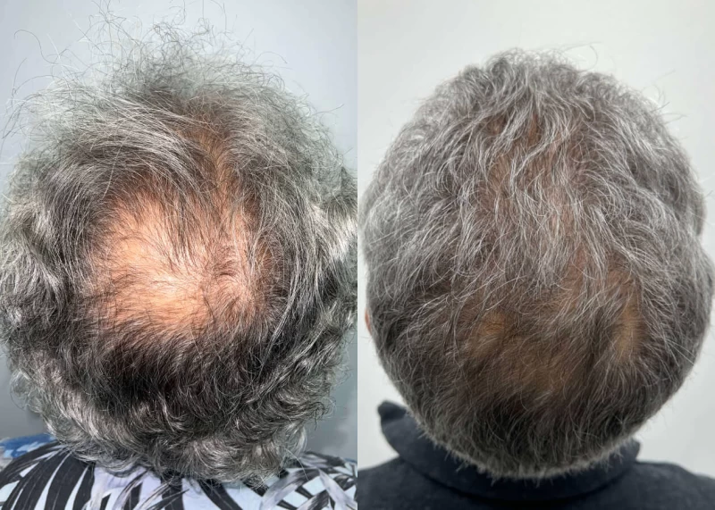 Patient p506 hair transplant before and after crown view