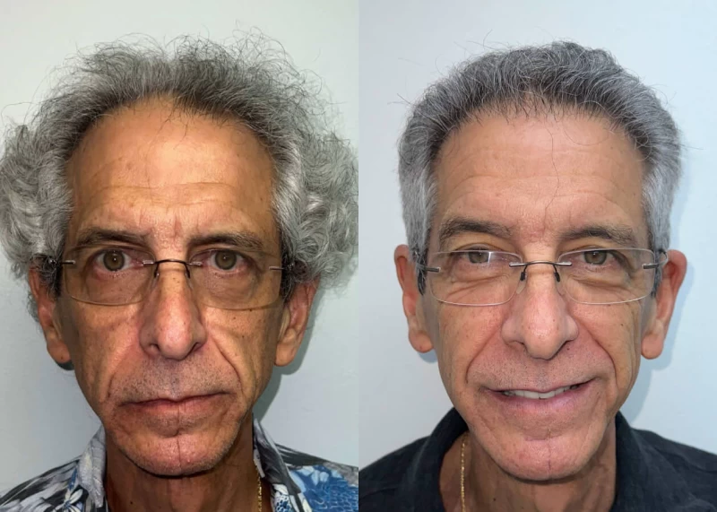 Ira Hair Transplant Before and After