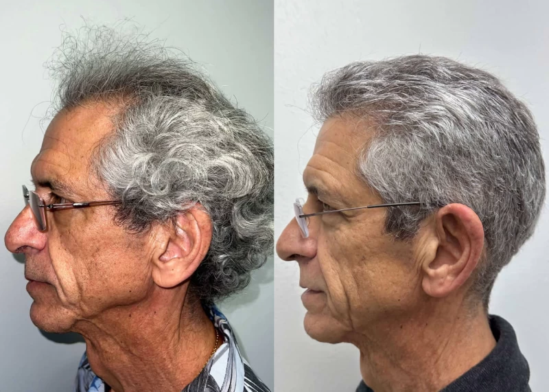 Patient p506 hair transplant before and after left view