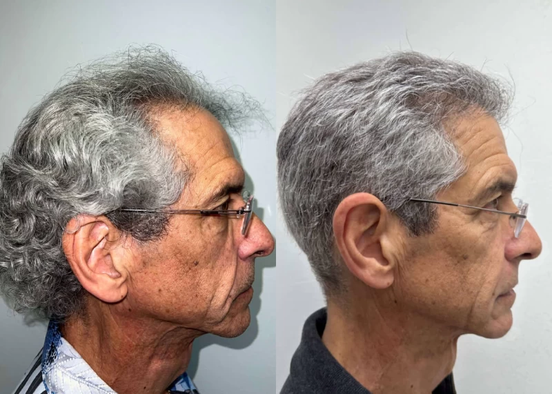 Patient p506 hair transplant before and after right view
