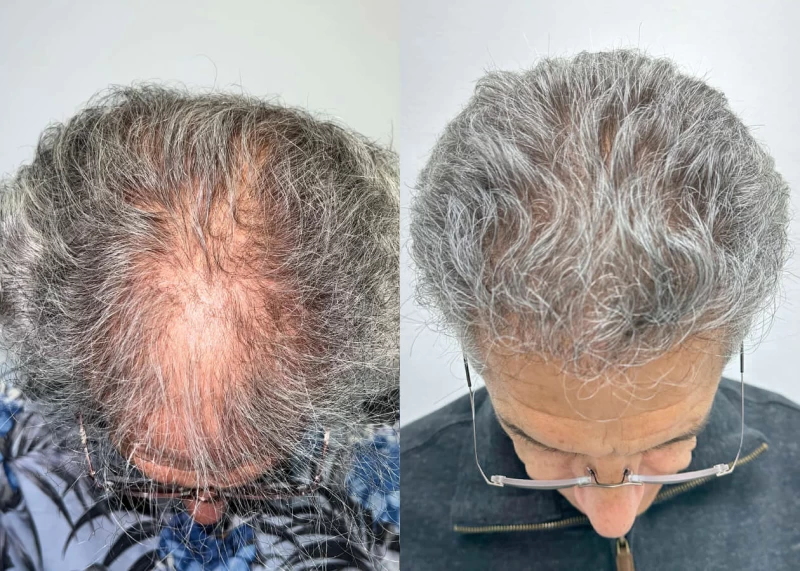 Patient p506 hair transplant before and after tilt view
