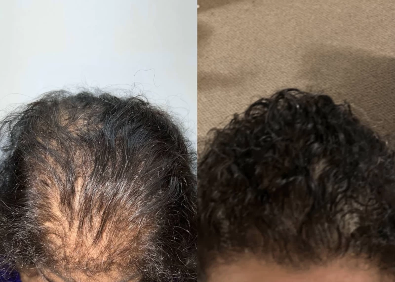 Patient 507 Hair Transplant Before and After