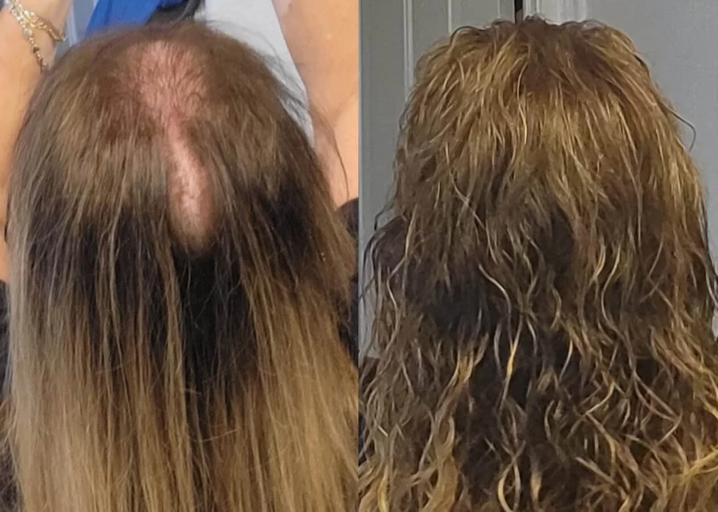 Patient p508 hair transplant before and after crown view