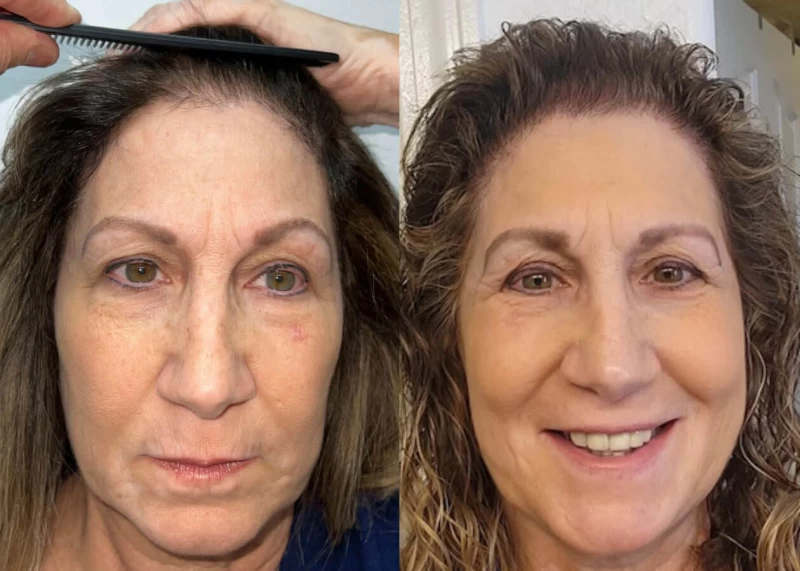 Maryanne Hair Transplant Before and After