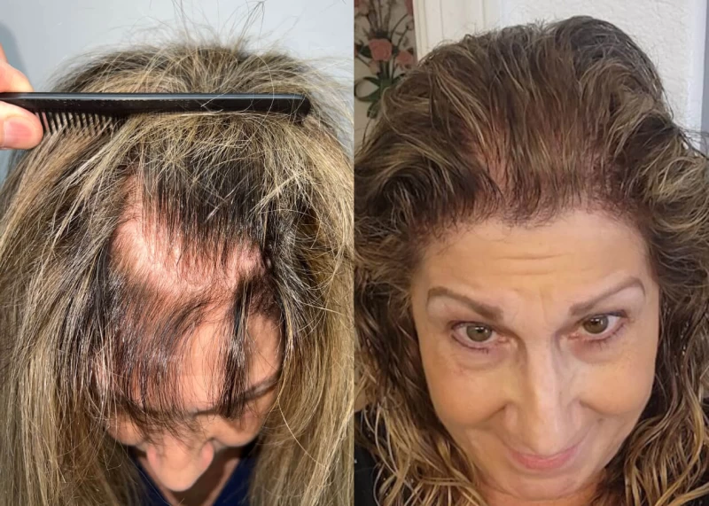 Patient p508 hair transplant before and after tilt view