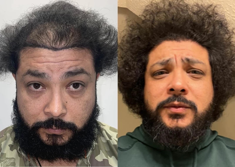 Bobby Hair Transplant Before and After