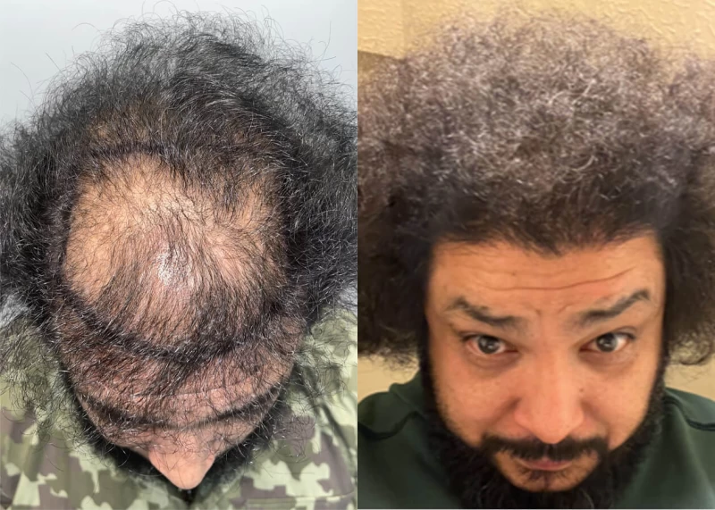 Patient p509 hair transplant before and after tilt view