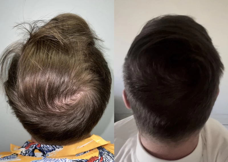 Patient p510 hair transplant before and after crown view