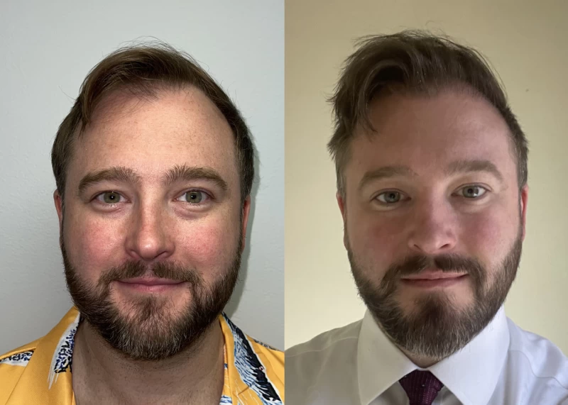 Dillion Hair Transplant Before and After