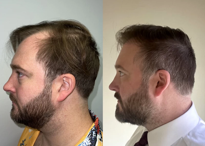 Patient p510 hair transplant before and after left view