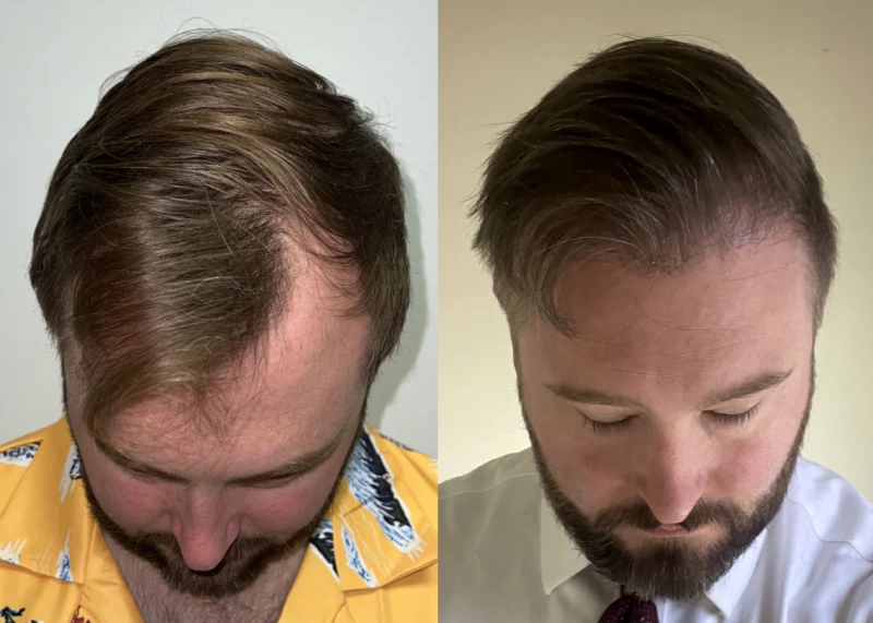 Patient p510 hair transplant before and after tilt view