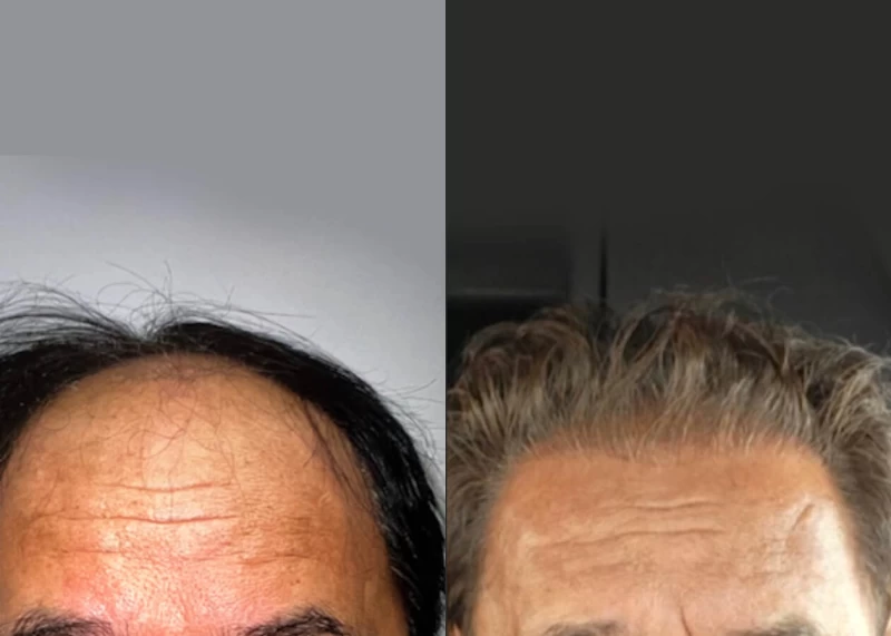 Patient 511 Hair Transplant Before and After